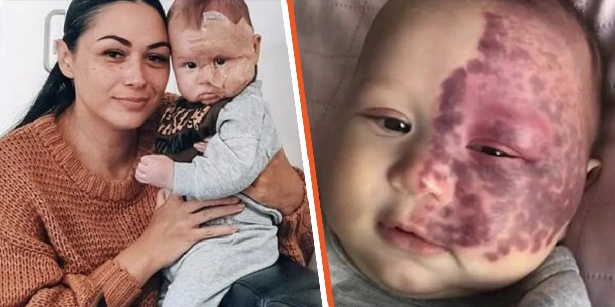 Mom Labeled a 'Monster' for Lasering Her Baby's Port-Wine Stain Birthmark 